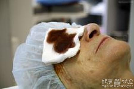 治療白內障時的注意事項