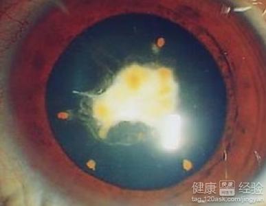 白內障該怎麼辦？