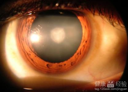 怎樣可以預防白內障
