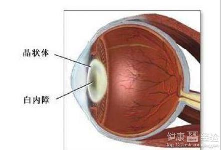 白內障可以不做手術治療嗎