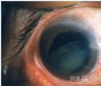 眼睛裡面有白色的膜是怎麼回事啊