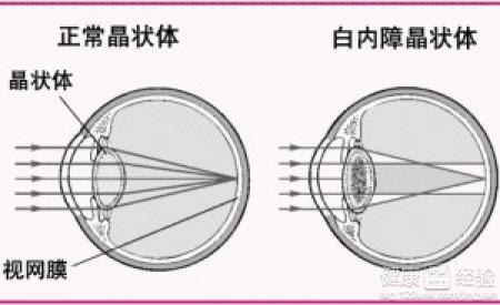 白內障的飲食治療方法