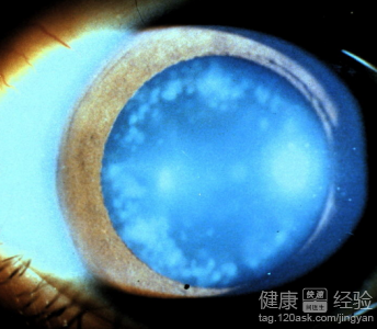 白內障患者術後如何護理