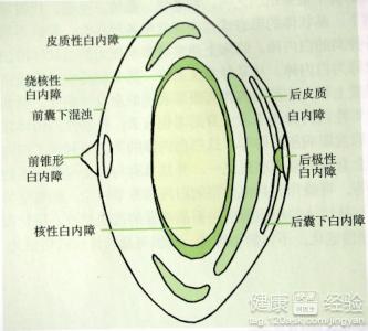該怎麼預防白內障