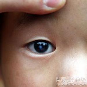 先天白內障對近視的影響有多大？