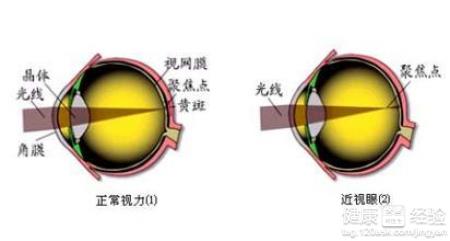 揭秘小孩子容易患近視原因