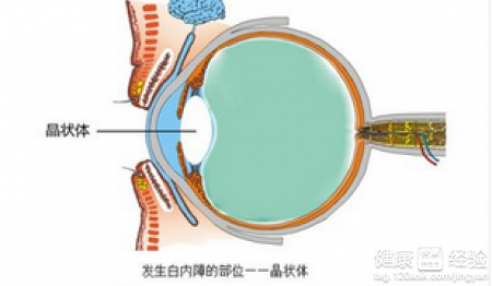 奇！“老花鏡”可以防近視