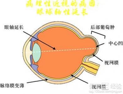 病理性近視有5大特點