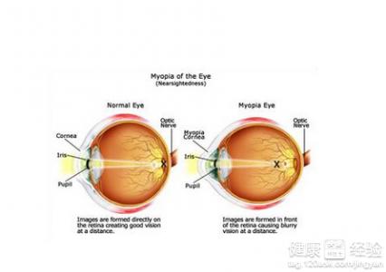 針灸可以治療近視嗎