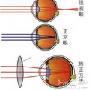 如何治療近視眼