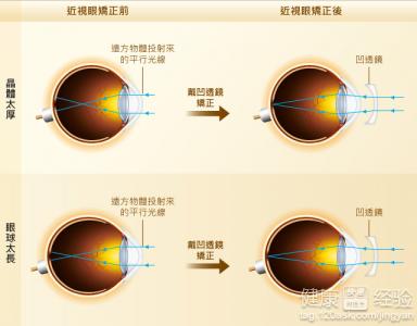 近視眼容易與哪些疾病混淆