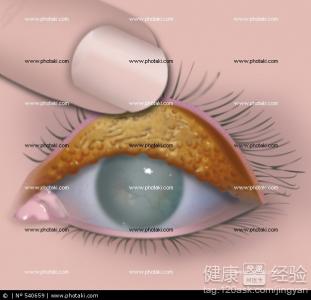 為什麼會得近視眼