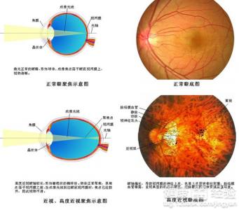 近視眼多少度為高度近視