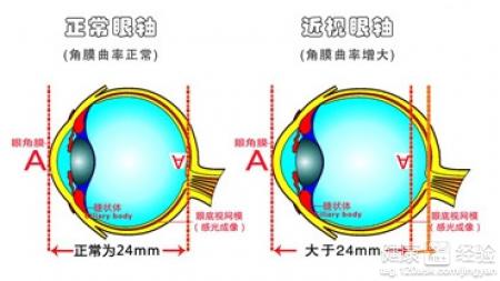 近視眼做手術需要多長時間