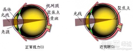 近視眼鏡需要每天佩戴嗎