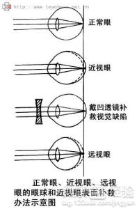 近視眼做手術風險大嗎