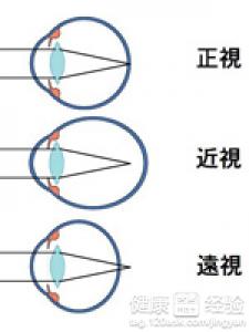 三年的近視眼能夠用藥物治療好嗎