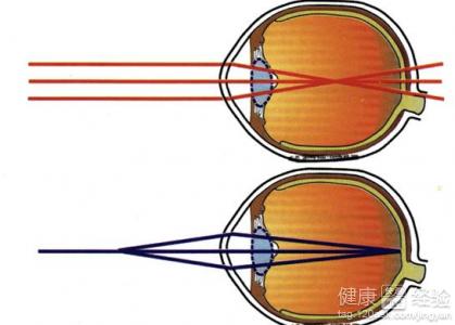 手術治療近視眼效果怎麼樣