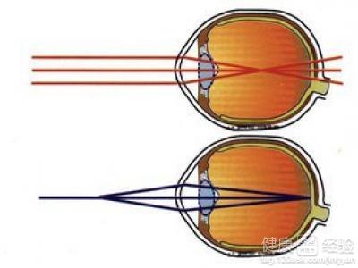 近視眼咋辦呢？