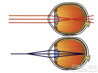治療近視眼