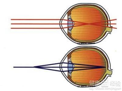 近視都會產生哪些症狀呢？