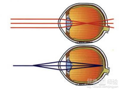 真性近視和假性近視有什麼區別？