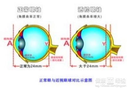 近視眼怎麼治療？