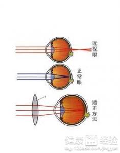 多種原因導致兒童遠視遠視眼跟年齡的關系很大