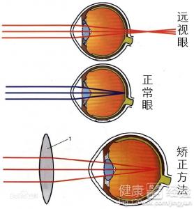 3種遠視眼症狀早知道矯正遠視要注意哪些問題