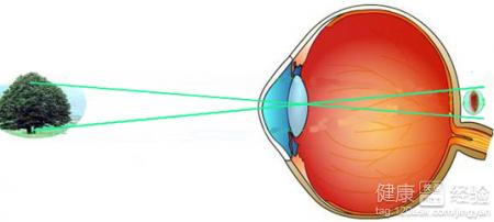 遠視眼患者的4大症狀遠視眼需要做哪些檢查?