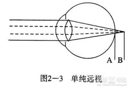 多種原因誘發遠視眼遠視矯正應注意事項