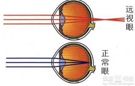 遠視眼有哪些具體表現？遠視的辨證論治