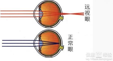 矯正遠視有三小原則以防止視力迅速下降