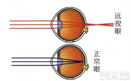 遠視眼與正常眼區別遠視是如何形成的