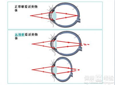 中醫氣功五招防遠視眼