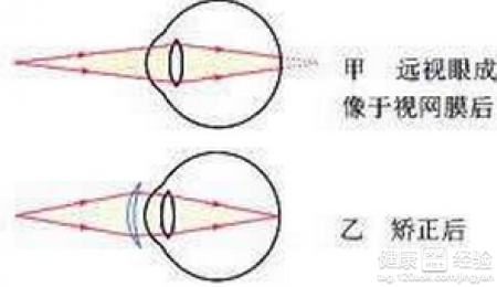 全面解析兒童遠視眼