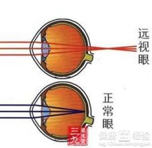 遠視眼常見的3個症狀