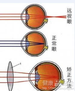 遠視眼做激光手術有哪些要注意的