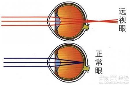 兒童遠視眼有哪些症狀