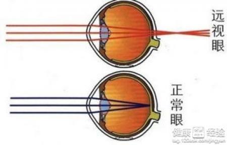 如何對遠視眼的弱視訓練