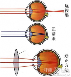 遠視眼是怎麼形成的