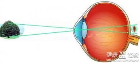 先天性遠視眼術後該如何護理