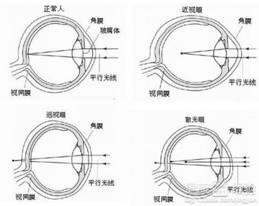 先天性遠視眼術前要做哪些准備工作