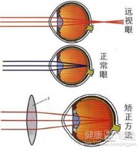 什麼樣的遠視眼鏡會影響視力恢復