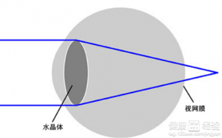 遠視眼不治療會導致度數加重嗎