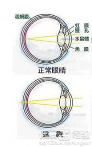 左眼有輕度遠視眼要如何調整