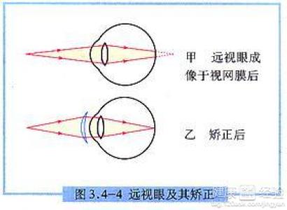 用什麼方法可以知道自己遠視眼的度數