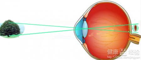 什麼壞習慣會導致眼睛變遠視眼