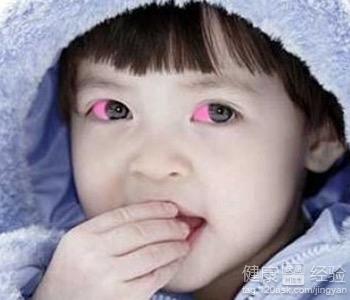 消“紅眼”需對症下藥治療紅眼病的常用驗方