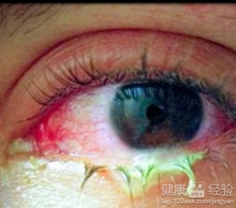 依賴電腦當心惹上紅眼病防治紅眼病傳播有五招